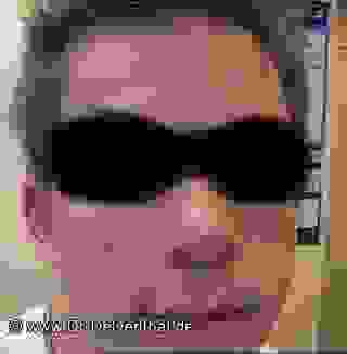 Akne Wenn Nichts Anders Hilft Isotretinoin Therapie