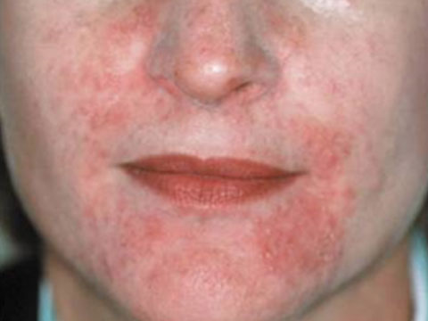 Periorale Dermatitis (Rosaceaartige Dermatitis, Stewardessen- oder Mannequinkrankheit)